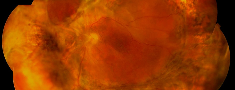 desprendimiento de retina